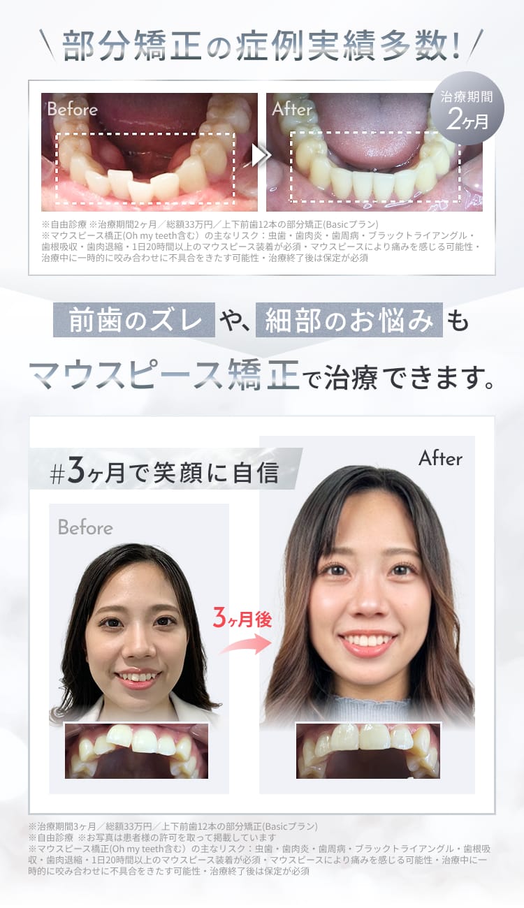 部分矯正の症例実績多数!前歯のズレや、細部のお悩みもマウスピース矯正で治療できます。
